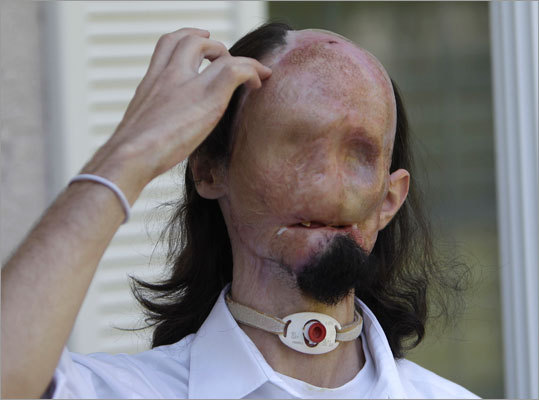 美国成功实施首例“全脸换脸”手术(高清组图)