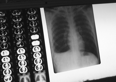 卫生部调查数据称中国超过5亿人感染结核病菌