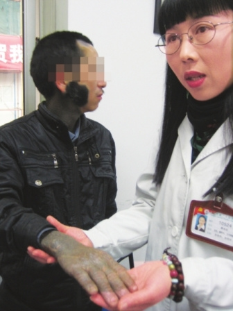 男子患怪病全身长满毛发续：医院将为其免费治疗