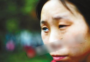 19年前右眼被刺瞎 如今“眼珠”经常滚落出来