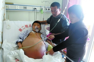 20岁男孩腹部持续变大无法下床 腹围140多厘米