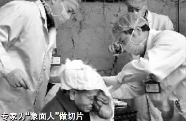 “象面人”引关注 专家会诊拟为其变脸