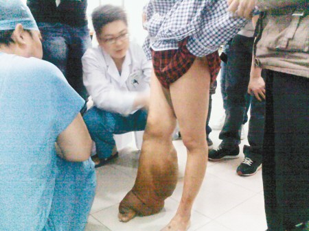 少女小腿粗如“象腿” 抬脚行走如拖一袋面