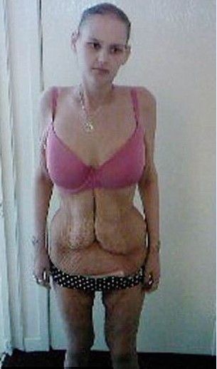 原英国最胖少女患上厌食症体重仅剩1/4