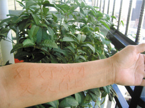 65岁女士皮肤能写字 医生疑是划痕症(图)