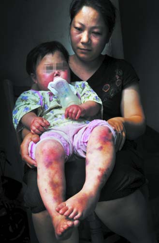 女孩接种卡介苗后出现异常反应 疾病缠身不长个