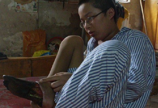初二男生患“黒脚”怪病 无钱医治难坏家人(图)