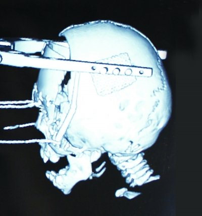 女婴脸面凹陷 仅1岁就需“撑骨”整形(图)