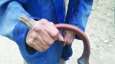 百岁老人患“皮角”皮肤病 手背长角10年(组图)