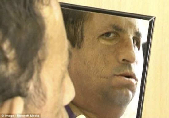 土耳其换脸人手术后首次长出胡子(图)