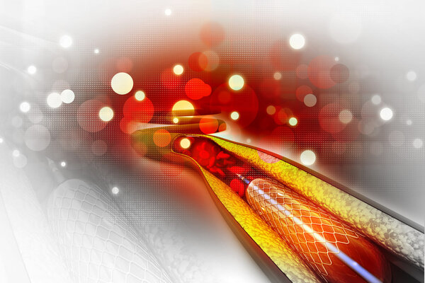 国产可降解涂层药物洗脱支架CREATE研究五年结果公布