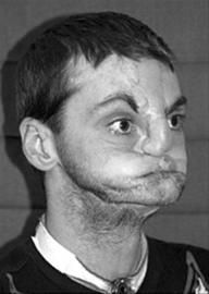 美国实施面积最大换脸手术(图)