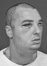 美国实施面积最大换脸手术(图)