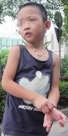 小子玉患有先天性的“螃蟹手”。