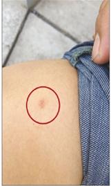 徐天腿部被扎伤。