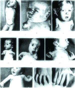 格兰泰公司推出的镇静剂撒利多胺曾导致全球许多新生儿先天畸形。(资料图片)