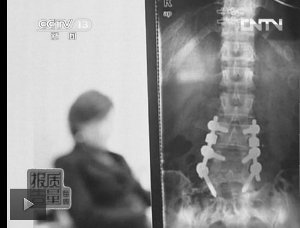 教练按压导致学员腰椎间盘突出。（央视截屏）。