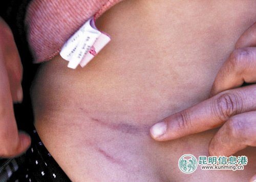 小杰身上的伤痕。