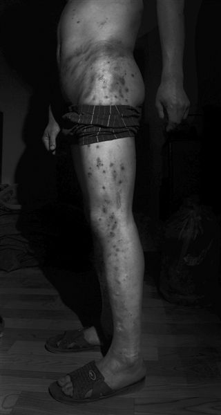 10月4日，湖北智障人士吴发兵腰部及腿部伤痕累累。他称，8月8日，他被骗到洗车行工作，多次遭领班殴打。