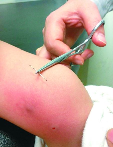 医生将缝衣针从秋晔的左膝盖里取了出来。