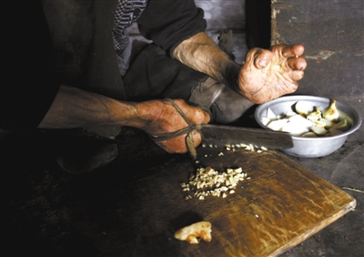 2012年11月20日，山石屏疗养院。一名失去手指的麻风病康复者，将菜刀绑在手掌上切菜