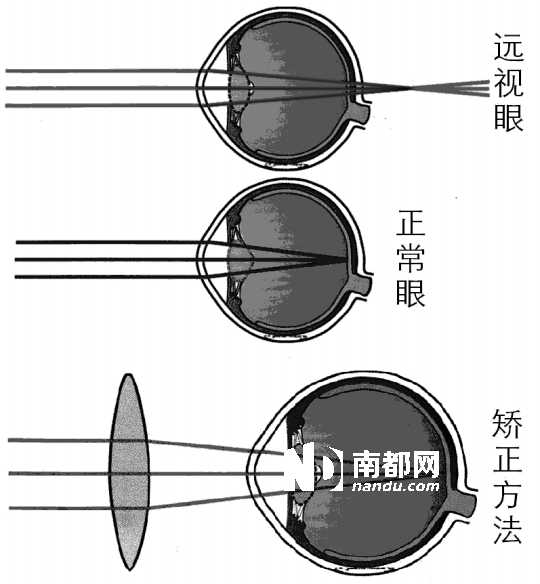 儿童远视不同于老花 远近都是看不清楚