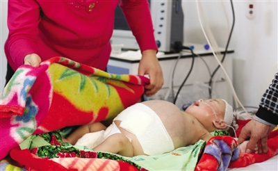 2月19日，八个月大的患儿康康肚子鼓得像个西瓜。