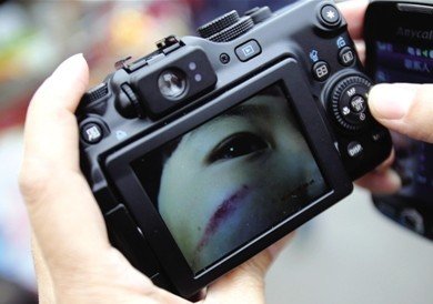 4岁女童脸部有明显伤痕。昨天,该女童称因吃饭慢被老师掐伤。园方表示将开除涉事老师。