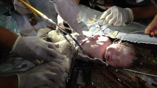 通过锯开的管道缺口，进一步运用钢锯和钳子的配合，裹住孩子头部的管道被拆除。