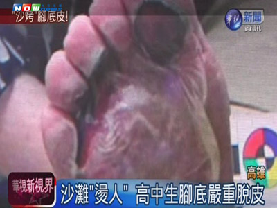 夏日高温不断创纪录，急诊室许多赤脚踩沙滩的病患，最严重的脚被烤焦。