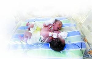 18岁女孩生下连体婴儿 亲友为双儿筹钱治疗(图)