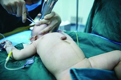 手术前的宝宝，心脏长在体外。