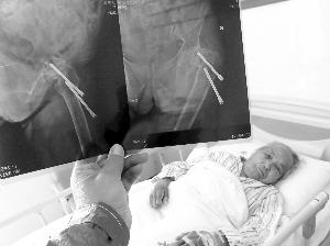徐州102岁老人动手术 从体内取出两颗螺丝